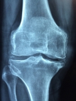 Biologická léčba artritidy by státu ušetřila peníze, pacientům se nedostává