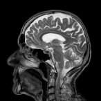Nádorů mozku v Česku přibývá, lékaři musí někdy operovat pacienta při vědomí